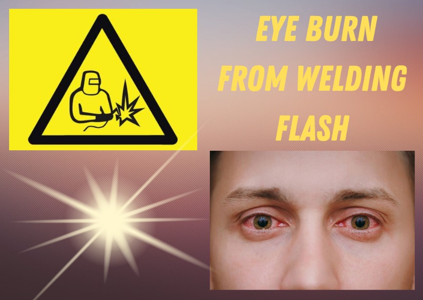 12 Best Home Remedies For Eye Burn From Welding Flash